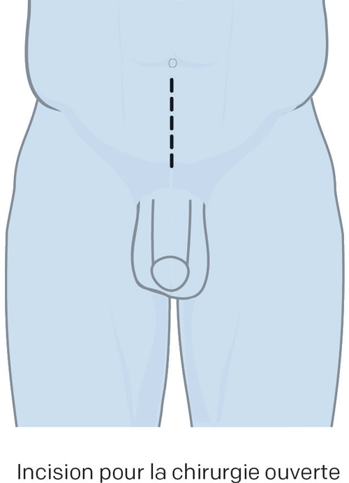 illustration incision chirurgie ouverte cancer prostate
