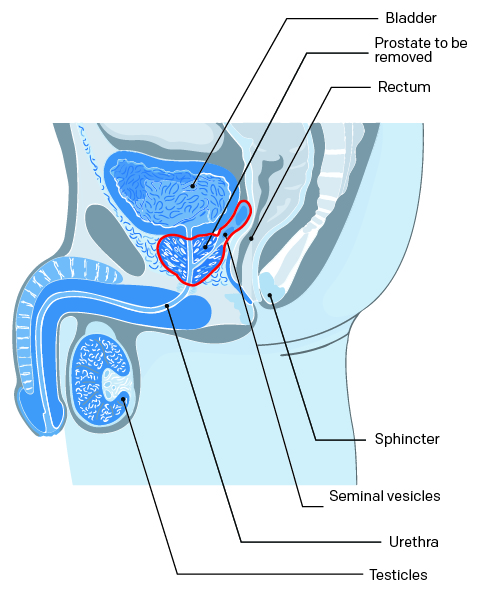 illustration chirurgie radicale prostate