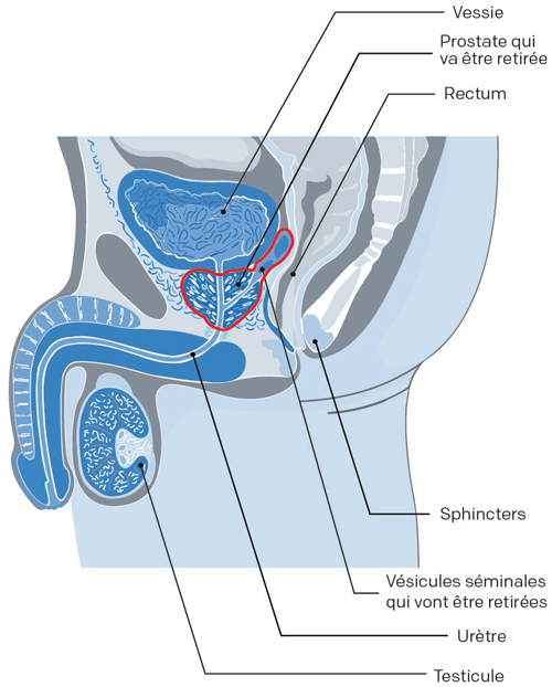 illustration chirurgie radicale prostate