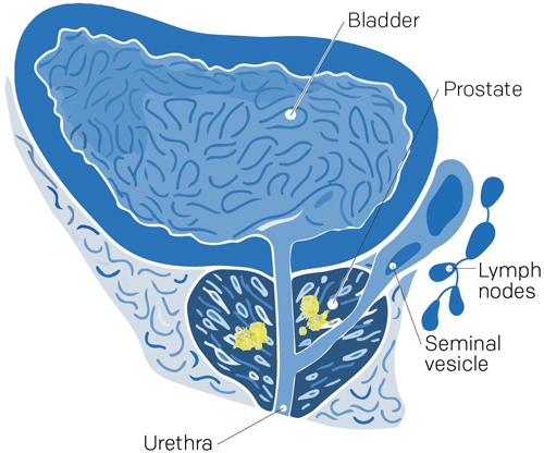 stade 2 cancer prostate