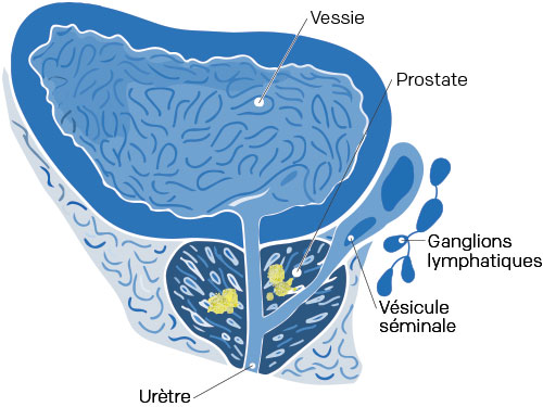 stade 2 cancer prostate