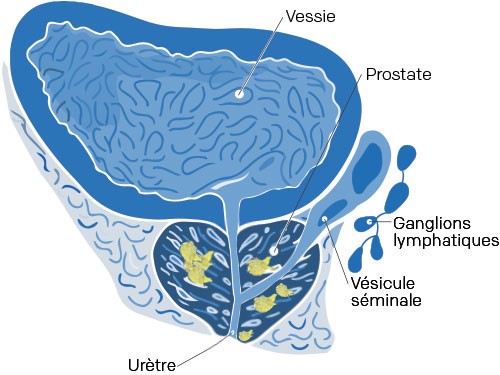 cancer / prostate phase terminale symptômes