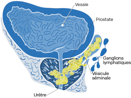 stade 3 cancer prostate