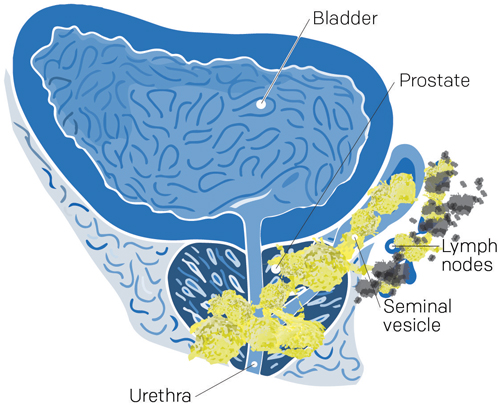 metastase cancer prostate
