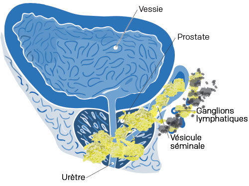 metastase cancer prostate