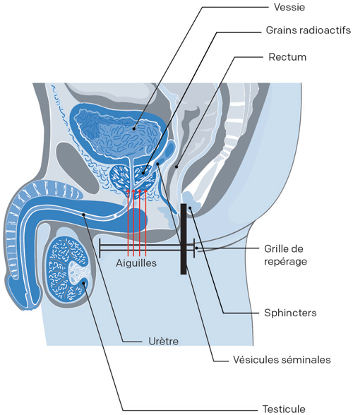 appareil de curiethérapie cancer prostate