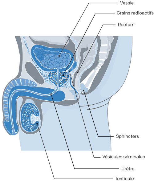 prostate avec grain permanent curiethérapie cancer prostate