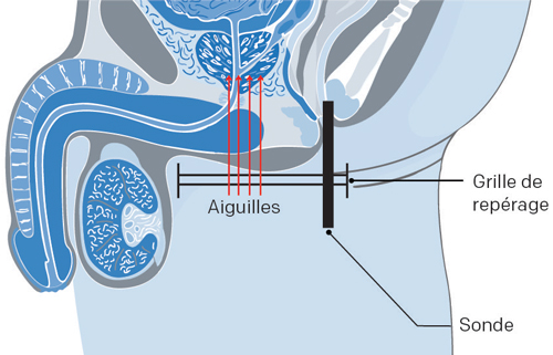 prostate avec curiethérapie haut débit cancer prostate