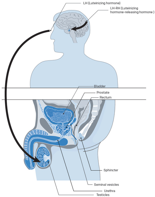 Illustration de l'effet de l'hormonothérapie pour un cancer prostate