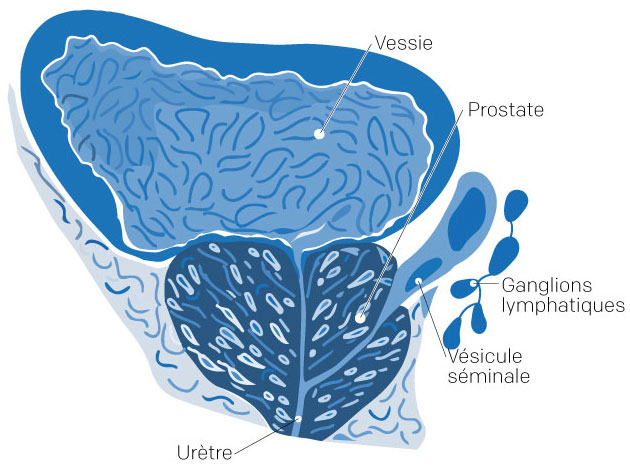 problème de prostate symptôme prostatitis bacteriana