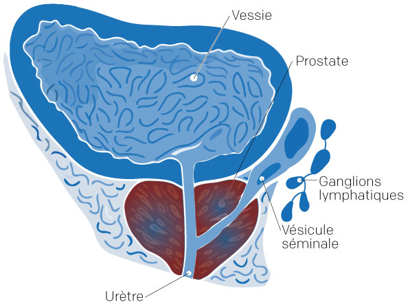 Illustration d’une prostatite