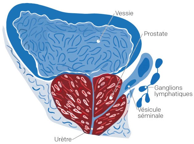 ganglion lymphatique prostate prostatite acuta terapia farmacologica