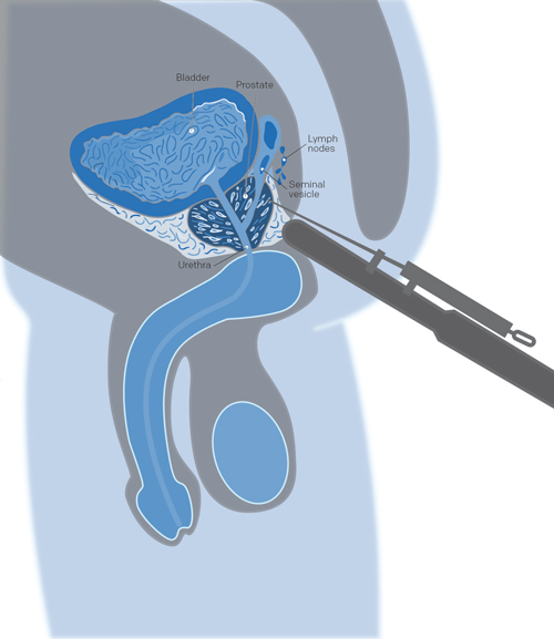 prostate and prostate biopsy