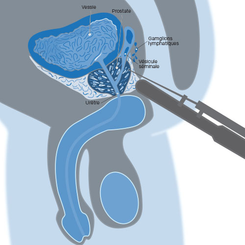 illustration biopsie pour surveillance active cancer prostate