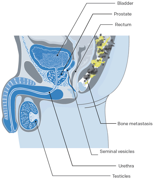 traitement des os cancer prostate