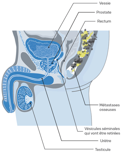 traitement des os cancer prostate
