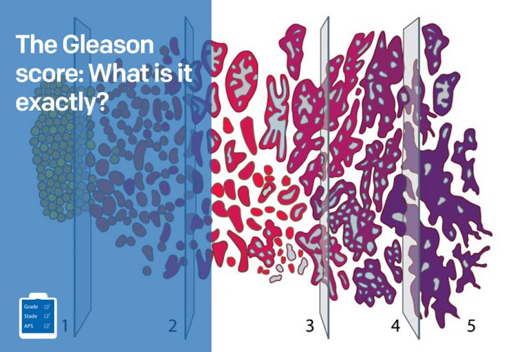 The Gleason score What is it exactly?