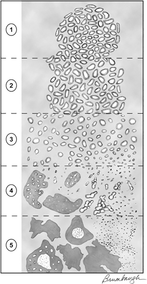 illustration grade de Gleason cancer prostate