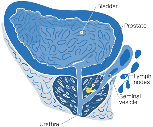 stade 1 cancer prostate