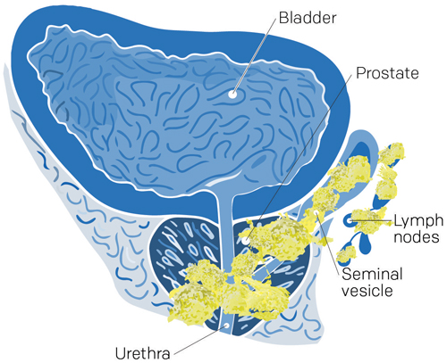 stade 4 cancer prostate