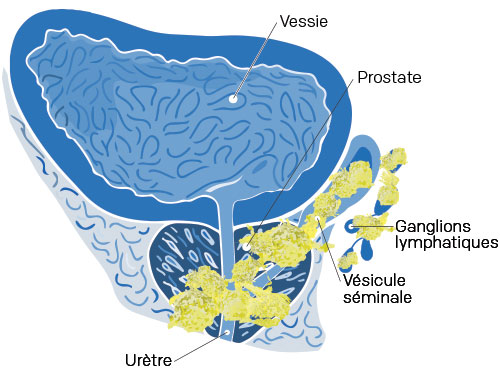 stade 4 cancer prostate