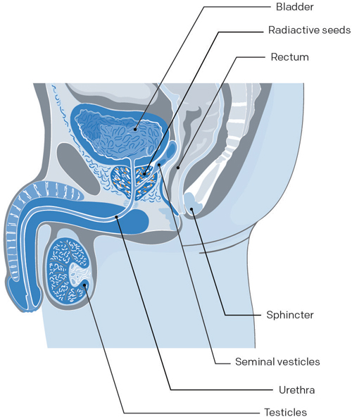 prostate avec grain permanent curiethérapie cancer prostate