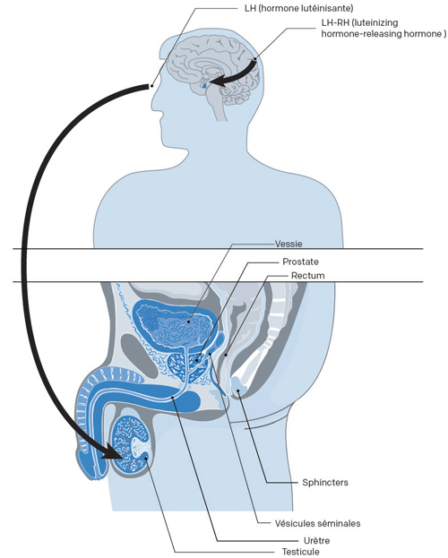 Illustration de l'effet de l'hormonothérapie pour un cancer prostate