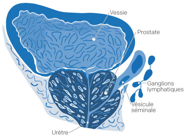 Signes et symptômes - Cancer de la prostate