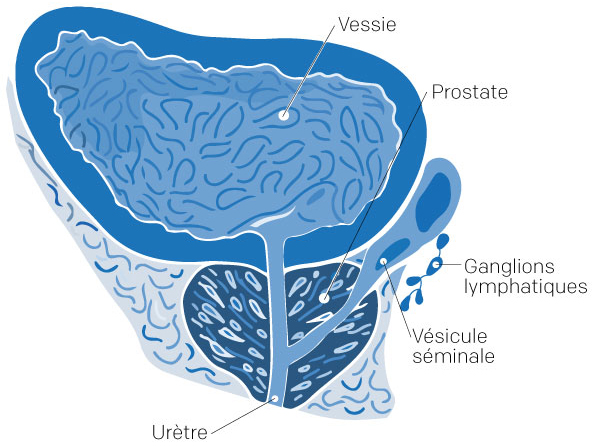 Illustration de l’appareil de l’homme pour un cancer prostate