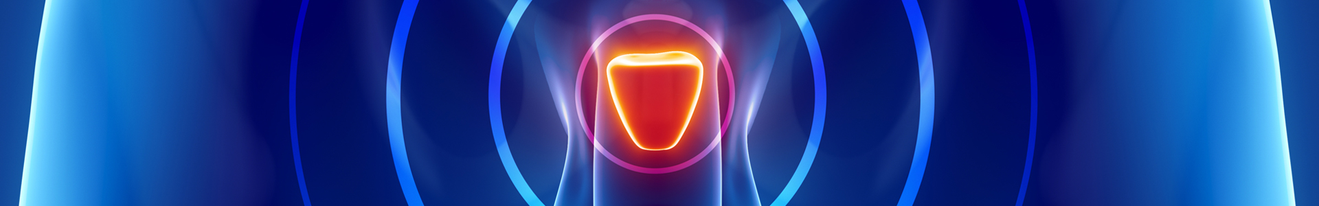 illustration ou photo d'une radiothérapie du cancer prostate