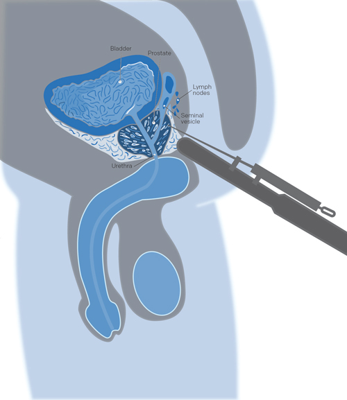 illustration biopsie pour surveillance active cancer prostate